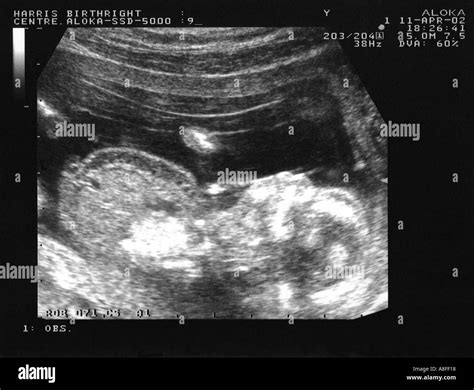 Fetus Abnormality Hi Res Stock Photography And Images Alamy