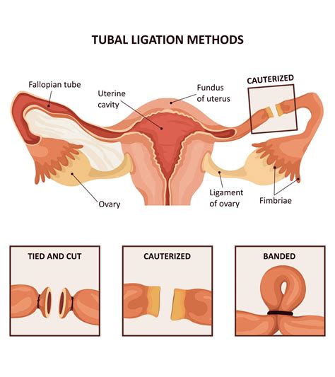 Tubal Ligation What It Is Procedure Benefits And Risks