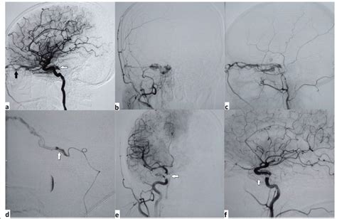 A Right ICA DSA Image Shows Opacification Of Right Cavernous Sinus