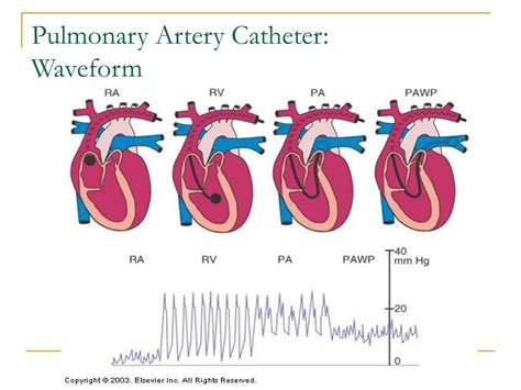 Pulmonary Artery Catheter