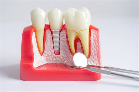 Single Tooth Replacement Inwhite Dental