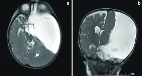 T2 Sequence axial and coronal magnetic resonance imaging (MRI) in of ...