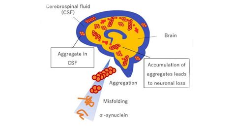 Novel And Rapid Device Opens New Doors For Parkinsons Detection