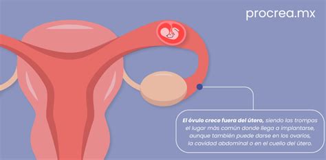 Embarazo Ectópico ¿por Qué Sucede Procrea