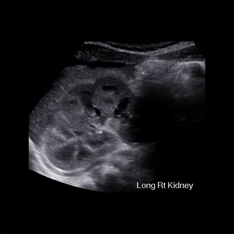 Fetal Lobulations of Kidney | Pediatric Radiology Reference Article ...