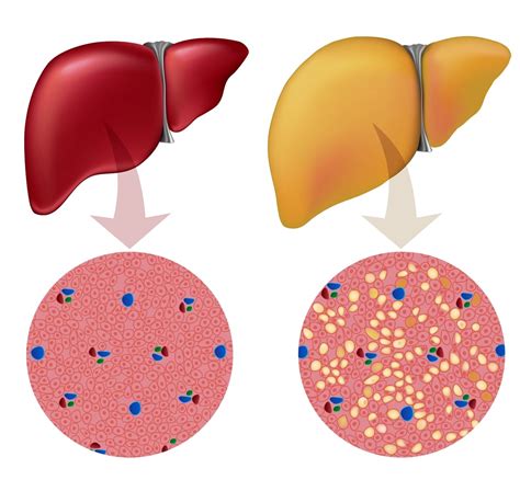 Hígado graso o esteatosis hepática y obesidad un problema en aumento