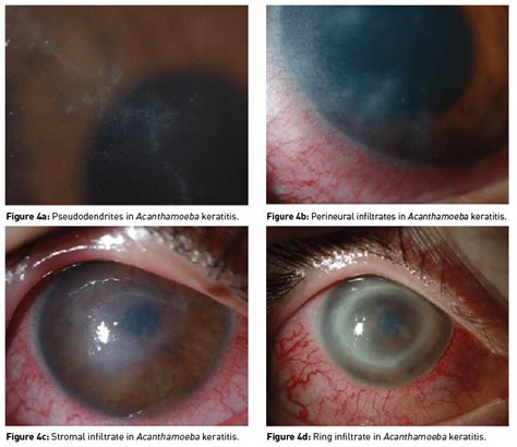 Acanthamoeba Keratitis Ring Infiltrate