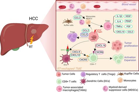 Changes In The Tme Of Hcc Before And After Radiotherapy Tme Of Hcc