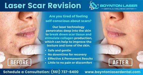 Laser Scar Revision Boynton Laser Dental Wellness Center