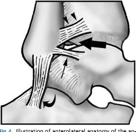 [pdf] Ankle Impingement Syndromes Semantic Scholar