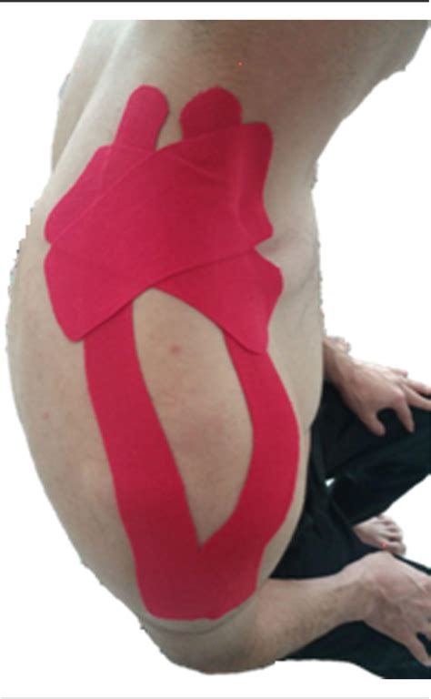 Figure 1 From The Short Term And Long Term Effects Of Kinesio Taping On