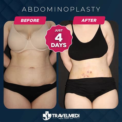 Abdominoplasty Travelmedi