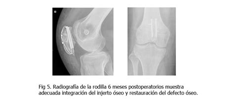 Tratamiento De La Osteomielitis CrÓnica Posoperatoria De La RÓtula