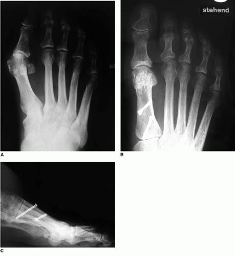 Oblique First Metatarsal Osteotomy: Ludloff | Musculoskeletal Key