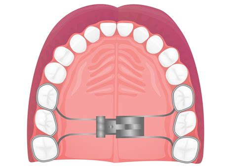 The Ultimate Guide For Palatal Expander Aria Dental