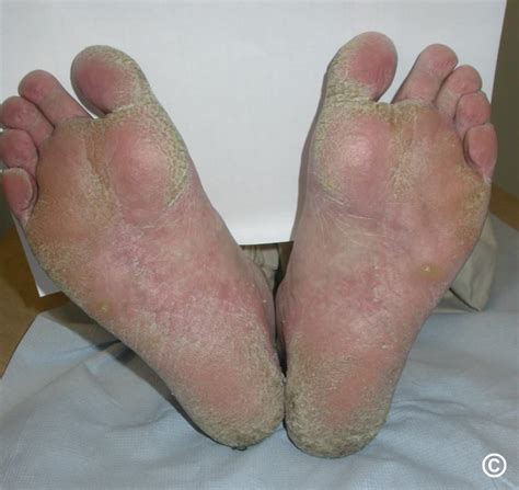 Palmoplantar Keratoderma Causes And Treatment 51 Off