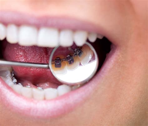 Lingual Braces Amazing Smiles