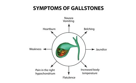 Gallstonescholelithiasis Cholecystitis Drvikram Ramamurthy