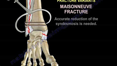 Ankle Fractures Special Situations Everything You Need To Know Dr