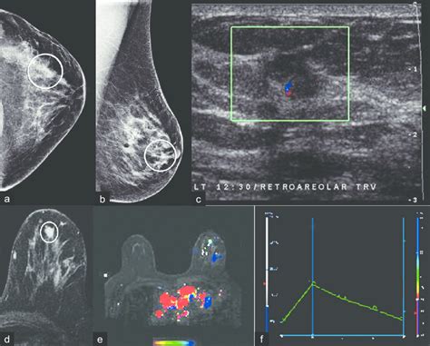 invasive ductal carcinoma  cc   mlo views   left breast