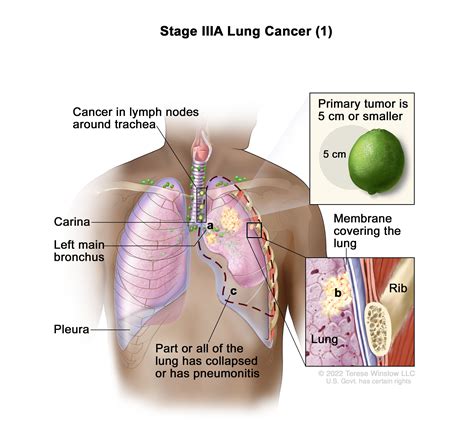 Non-Small Cell Lung Cancer Treatment - NCI