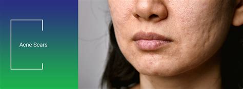 Prp For Acne Scars Prp Treatment For Acne Scars Bay Medical Aesthetics