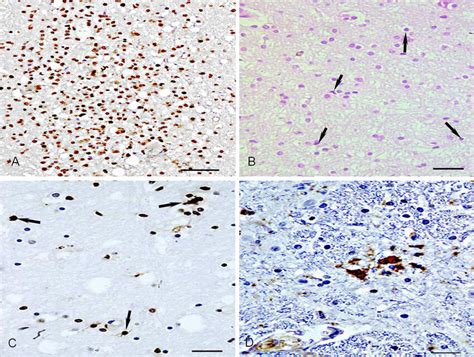 Mild Cdv Infected Pyramidal Cells A Lots Of Cdv Antigen Positive Cells