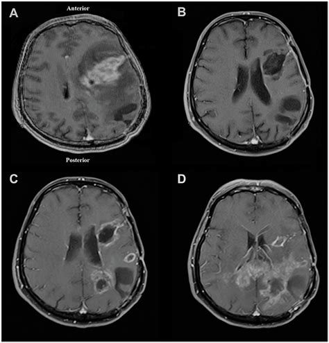 Frontiers Case Report Stem Cell Based Suicide Gene Therapy Mediated