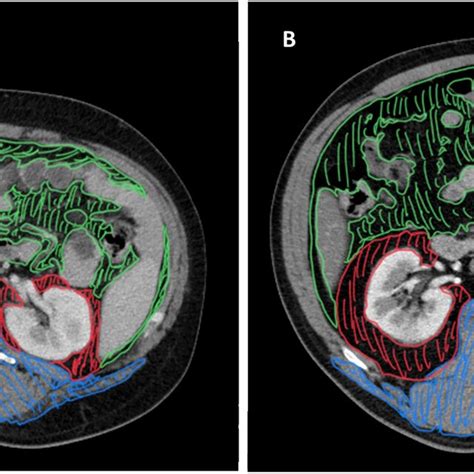 Representative Examples Of Adiposity Measures Using Ct Scan Axial