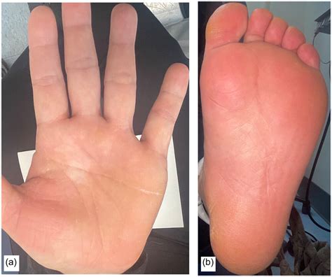 Palmoplantar Keratoderma Climactericum Successfully Treated With