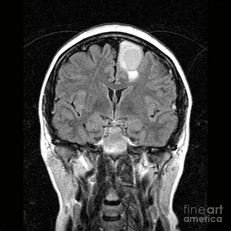 Brain Tumour 36 By Simon Fraser Science Photo Library