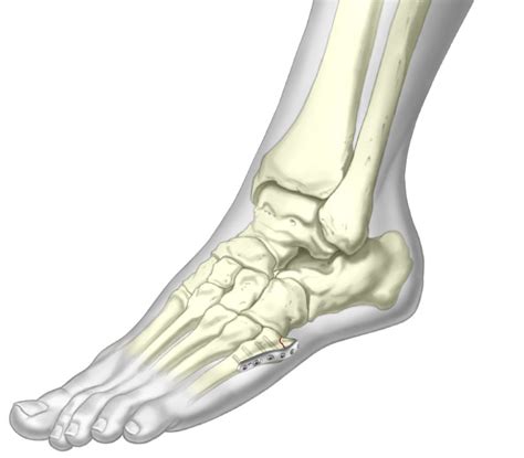 Jones Fracture Plate 5th Metatarsal Implant Trimed Inc