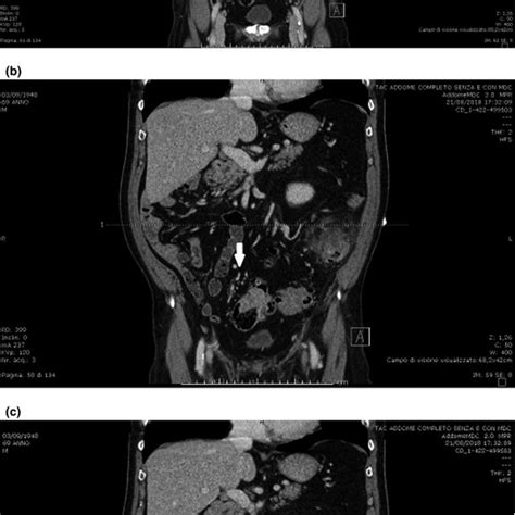 Intracorporeal Stapled Anisoperistaltic Ileosigmoid Anastomosis Download Scientific Diagram