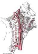 Carotid Artery Stenosis Wikipedia