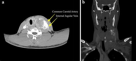 Computer Tomography A Axial Soft Tissue Window Ct With Contrast Download Scientific Diagram