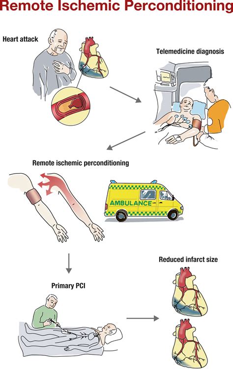 Remote Ischemic Conditioning For Patients With STEMI Michael Rahbek