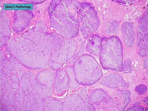 Qiao S Pathology Solid Papillary Carcinoma Of The Breast Flickr