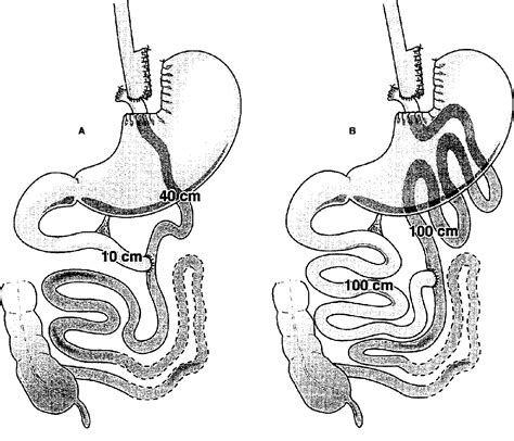 Roux En Y Gastric Bypass Afferent Limb