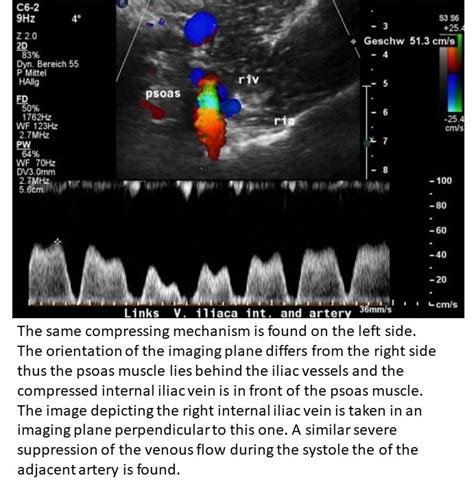 Detection of a new compression syndrome : Bilateral compression of the ...