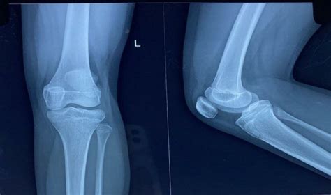 Anteroposterior And Lateral Radiographs Of Left Knee Download Scientific Diagram