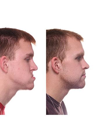 Corrective Jaw Surgery Scott Orthodontics Webster Tx