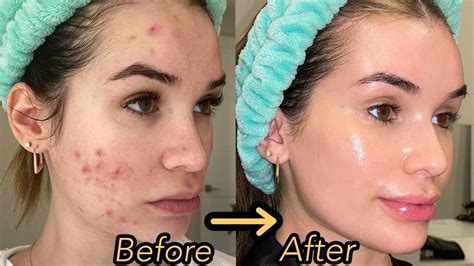 How I Finally Cleared My Acne And Textured Skin Hormonal Acne