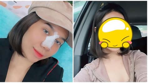 8 Potret Perubahan Wajah Mayang Usai Operasi Hidung Sudah Lepas Perban