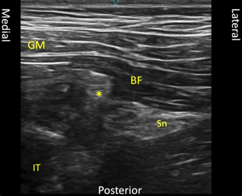 Transverse View Of The Proximal Posterior Thigh The Sciatic Nerve Sn Download Scientific