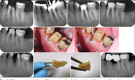 Figure 1 From Clinical And Histological Findings Of Post Treatment Infection In The Presence Of