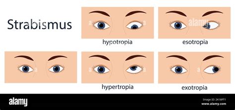 Strabismus Flat Style Infographic Set Of Stages Normal And Disorders