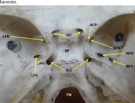 Figure 1 from Anatomic Variants of Foramen Ovale and Spinosum in Human ...