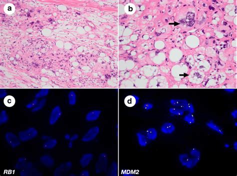 Histology Of Pleomorphic Liposarcoma Sitelip Org