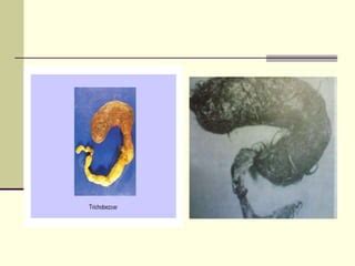 Trichobezoar Management Laparoscopic Ppt