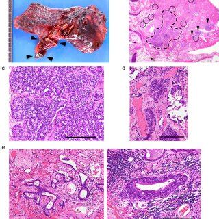 A Macroscopic Findings Showing A Cm Diameter Tumor In The Upper